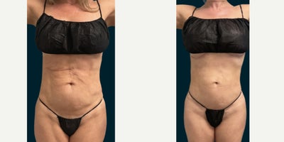 Tummy Tuck before and after photo