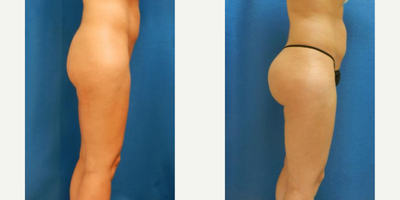 Brazilian Butt Lift before and after photo