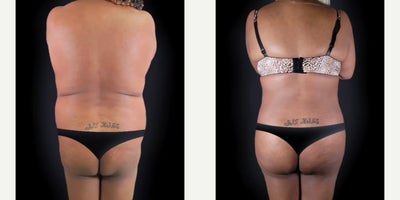 Brazilian Butt Lift before and after photo