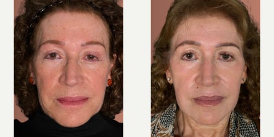 Chemical Peel before and after photo