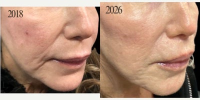 Dermal Fillers before and after photo