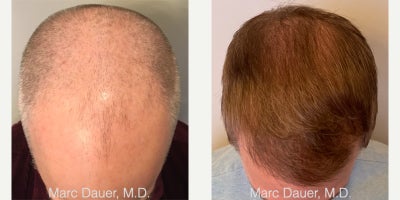 Hair Transplant before and after photo