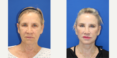Lip Lift before and after photo