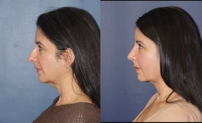 Rhinoplasty before and after photo