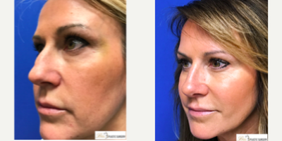 Rhinoplasty before and after photo
