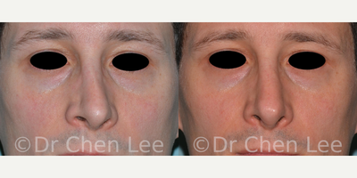 Rhinoplasty before and after photo