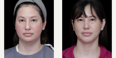 Rhinoplasty before and after photo