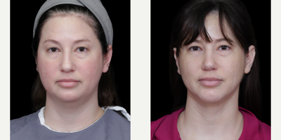 Rhinoplasty before and after photo