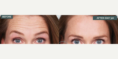 Botox before and after photo