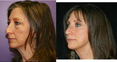 Cheek Lift before and after photo