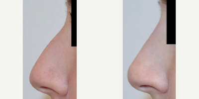 Restylane before and after photo