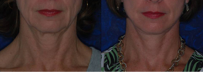 Facelift before and after photo