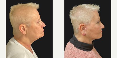 Facelift before and after photo