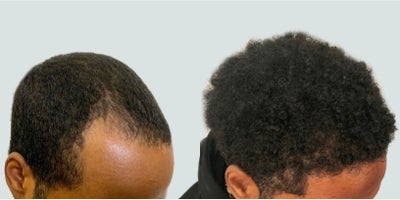Hair Transplant before and after photo