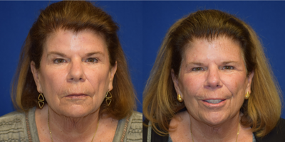 Lip Surgery before and after photo