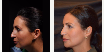 Nonsurgical Facelift before and after photo