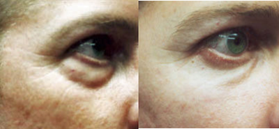Eyelid Surgery before and after photo