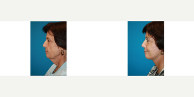 Facelift before and after photo