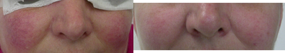 Laser Resurfacing before and after photo