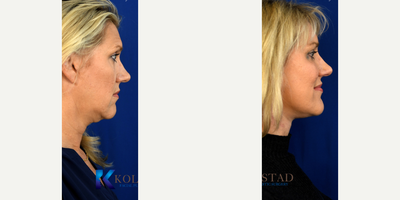 Lower Facelift before and after photo