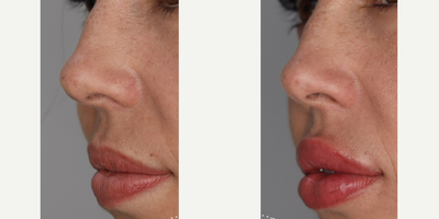 Revanesse before and after photo