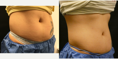 SculpSure before and after photo
