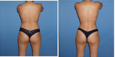 Tickle Lipo before and after photo