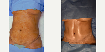 Tummy Tuck before and after photo