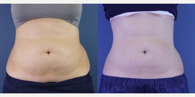 CoolSculpting before and after photo