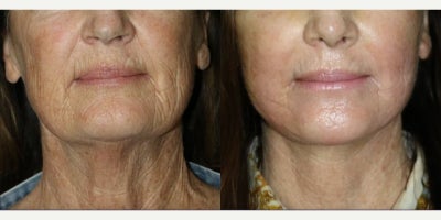 Neck Lift before and after photo