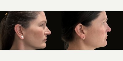 Septoplasty before and after photo
