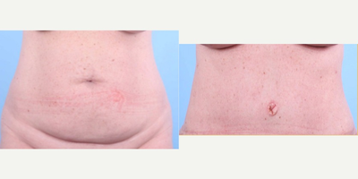 Tummy Tuck before and after photo