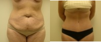 Tummy Tuck before and after photo