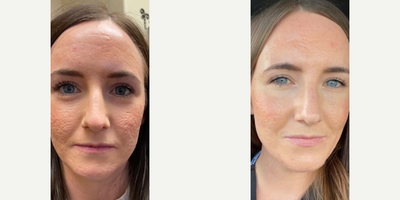 CO2 Laser before and after photo