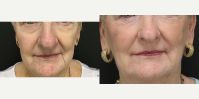Dermal Fillers before and after photo