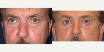 Eyelid Surgery before and after photo