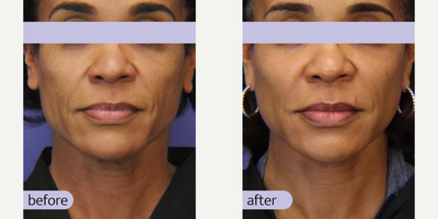 Facial Fat Transfer before and after photo