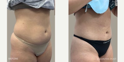 Laser Liposuction before and after photo