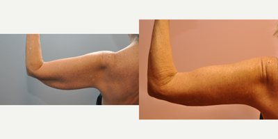 Body-Jet Liposuction before and after photo