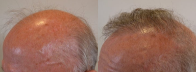Hair Transplant before and after photo