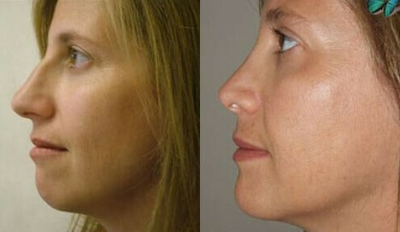 Rhinoplasty before and after photo