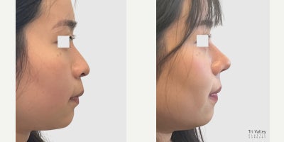 Asian Rhinoplasty before and after photo