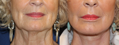 CO2 Laser before and after photo