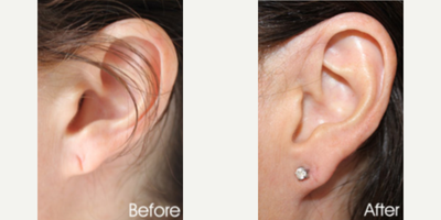Earlobe Repair before and after photo