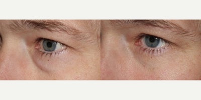 Eyelid Surgery before and after photo