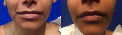 Facial Fat Transfer before and after photo