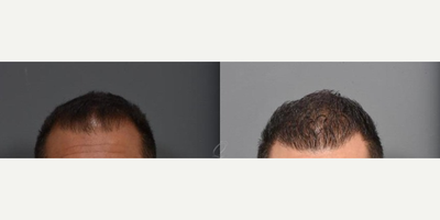 FUE Hair Transplant before and after photo