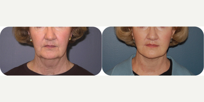 Lip Lift before and after photo