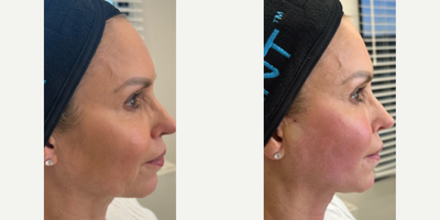 Nonsurgical Facelift before and after photo