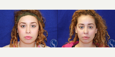Rhinoplasty before and after photo